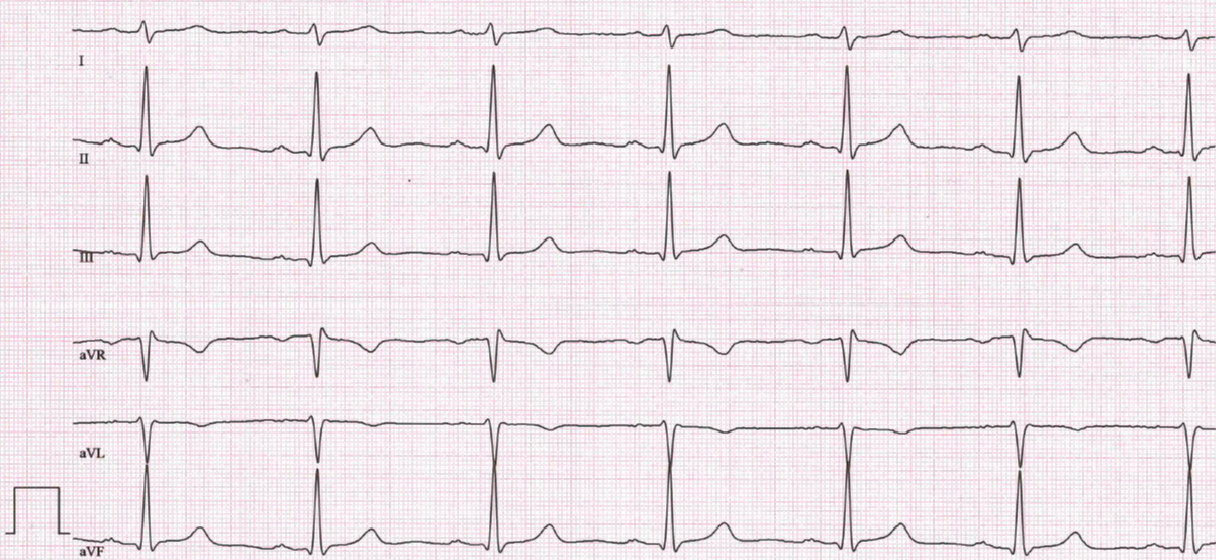 Wie Sieht Ein Normaler Ekg Aus