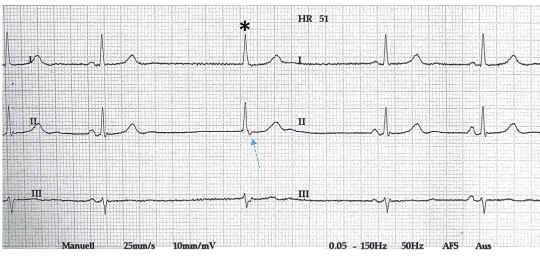 Supraventrikuläre Extrasystolen - Fokus-EKG