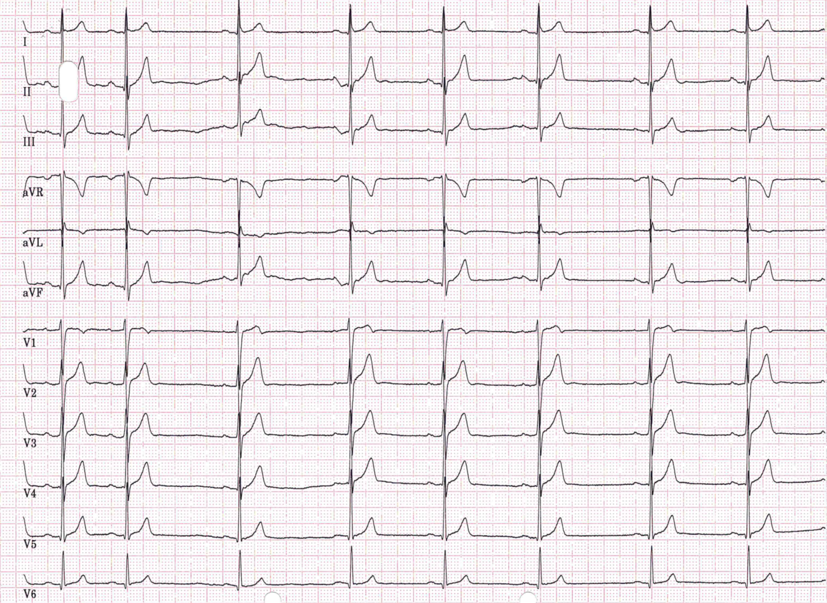 Sinusbradykardie Fokus Ekg