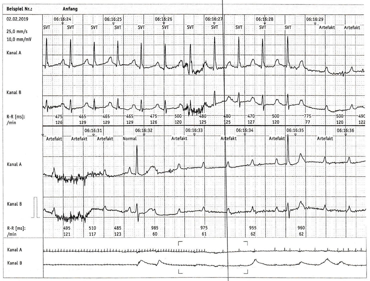 Atrioventrikuläre Blockierungen - Fokus-EKG