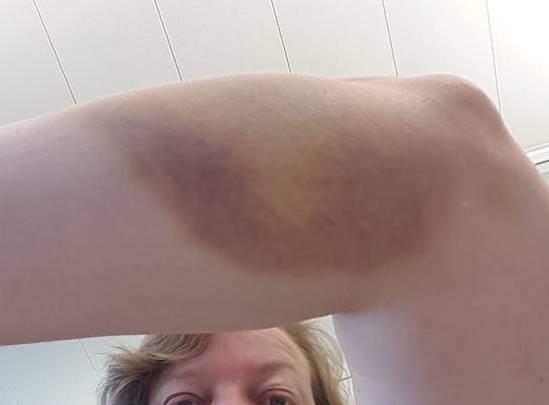 So sieht der Unterarm nach über einer Woche noch aus - aber gemäss Karin schmerzt er dafür nicht mehr :-)