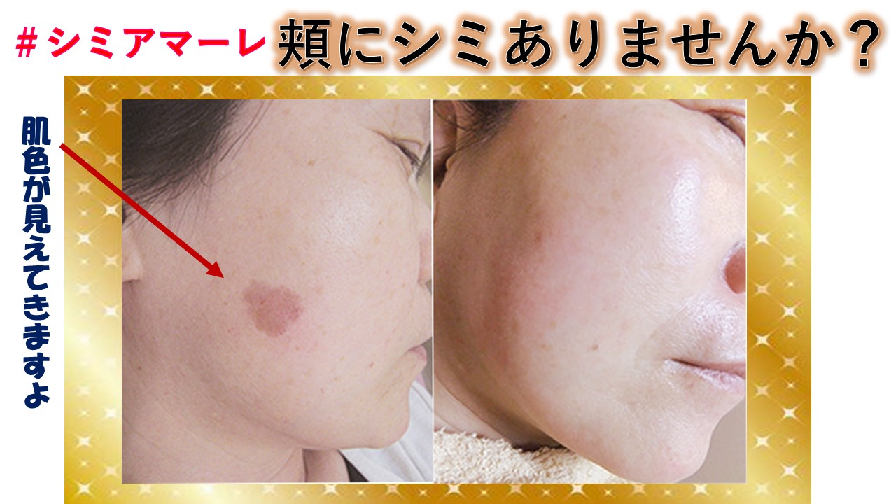 頬にシミがありませんか？