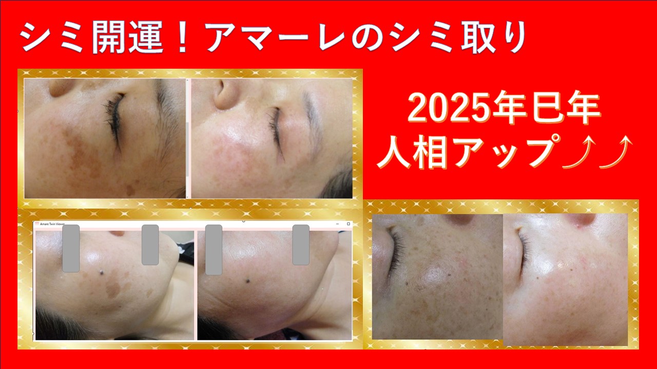 シミ開運！アマーレのシミ取り2025年巳年人相アップ