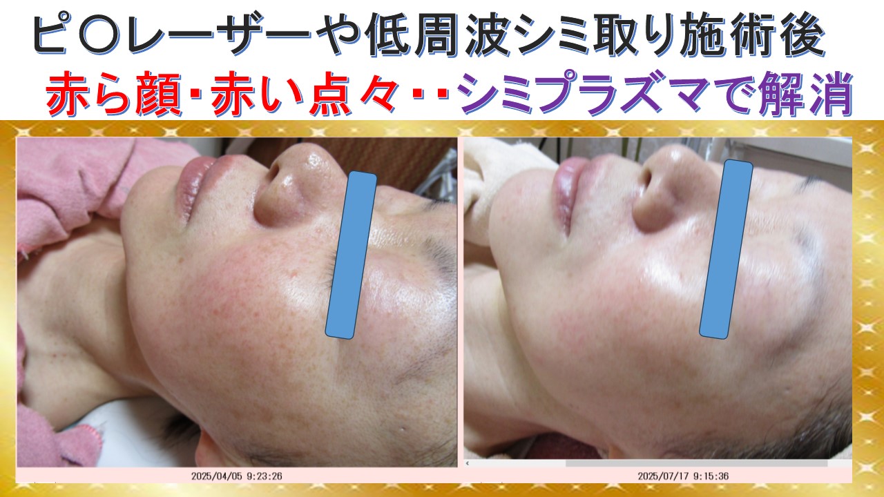 ピ〇レーザーや低周波シミ取り施術後　　　赤い顔・赤い点々・・・シミプラズマで解消