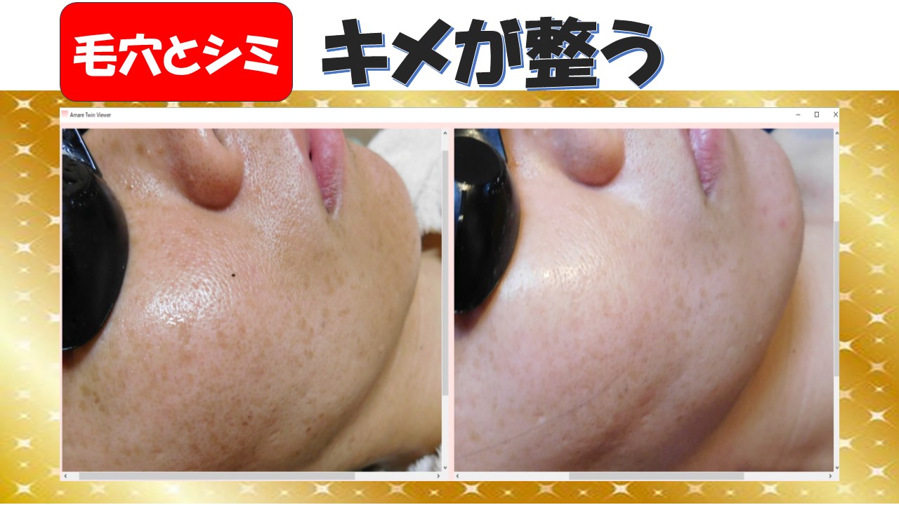 プラズマ・ハイドラ・ピーリング - 福井のシミ取りエステサロン アマーレ