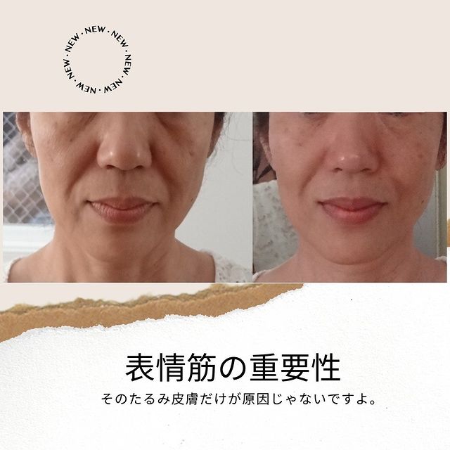ビューティーライザーたるみZEROで若返りたい