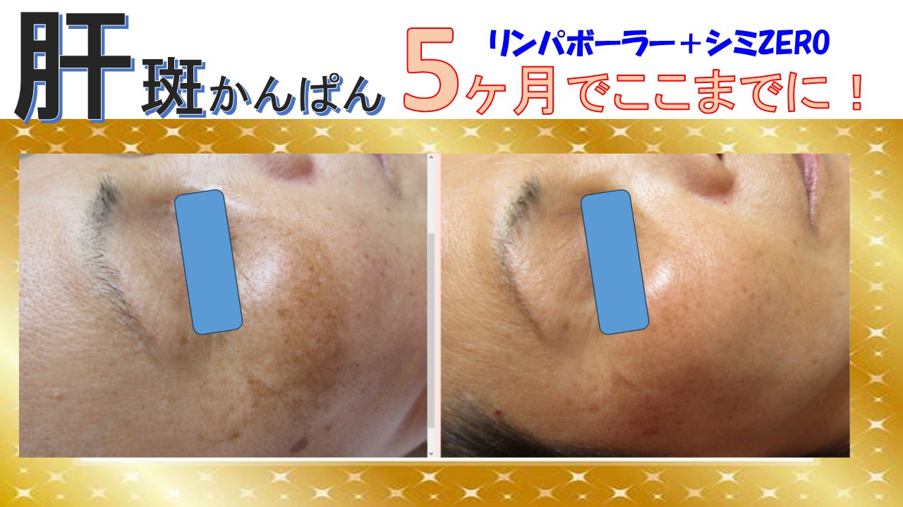 肝斑かんぱん5か月でここまでに