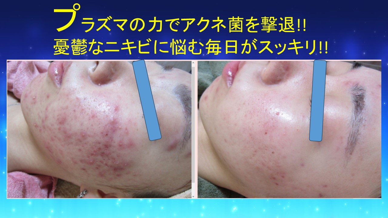 プラズマでアクネ菌撃退!!　　　　　　　　　　　　内側からスッキリしましょう!!