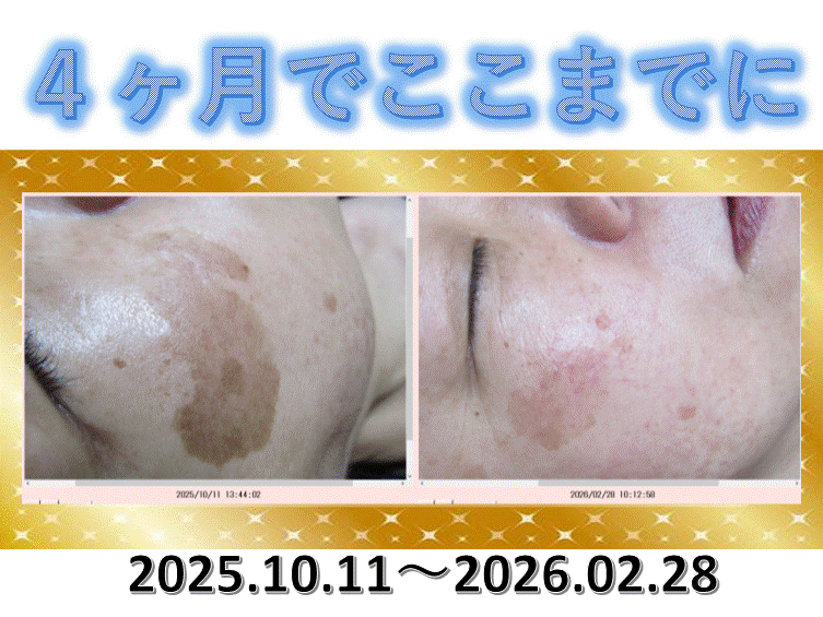 シミ4ヶ月でここまでに・・・