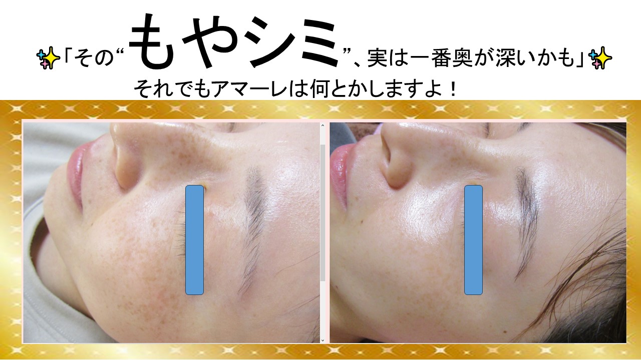 もやっとシミ、　　　　　　　　　　　　　　　　　　　　根本から動かすケア始めませんか？