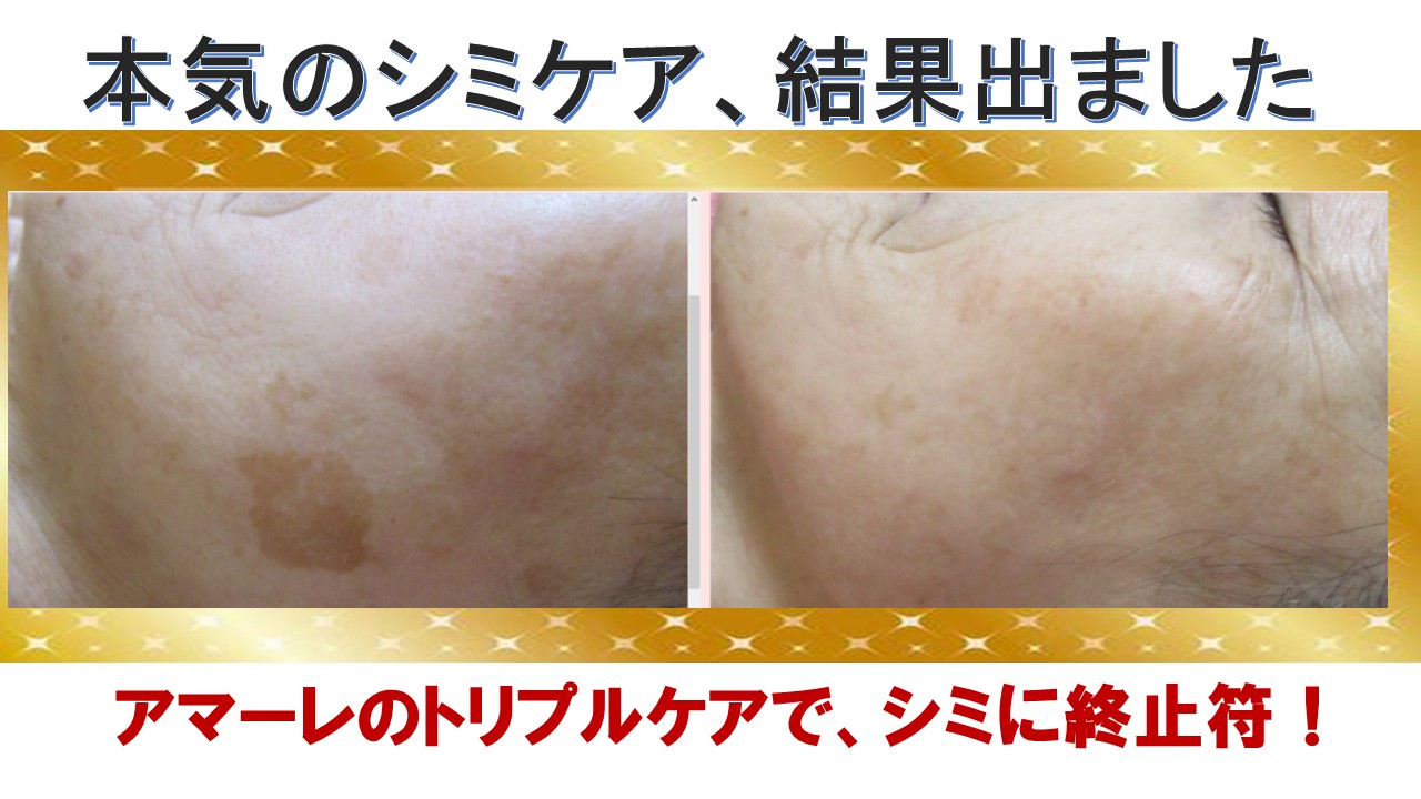 本気のシミケアで結果が出ました