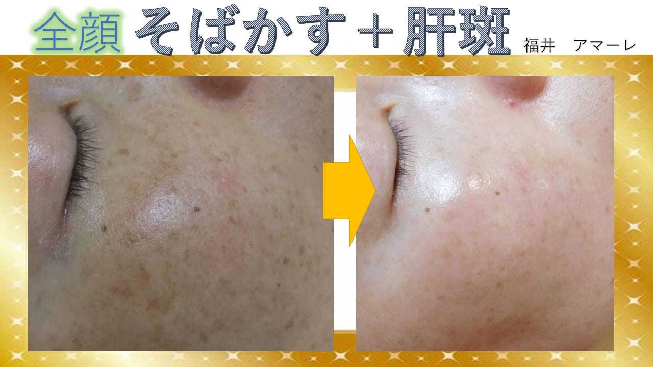 全顔そばかす＋肝斑ケア