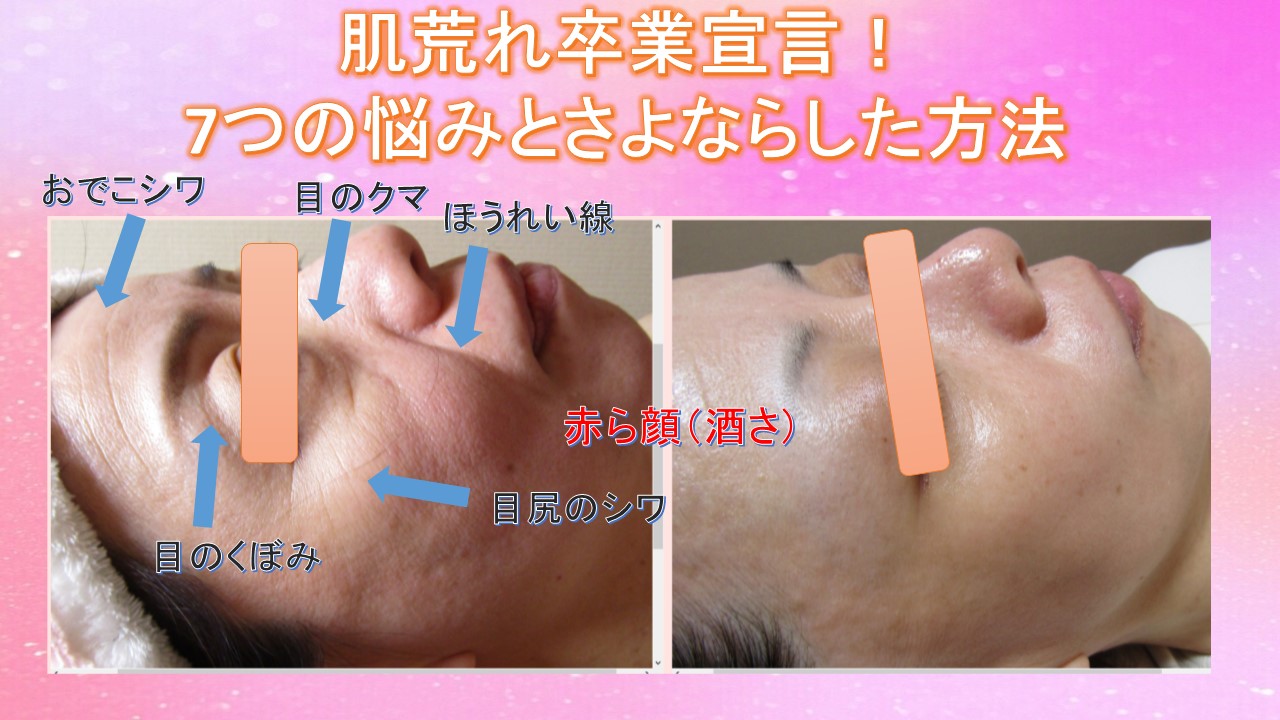 美肌宣言!!7つの悩みとさよならした方法