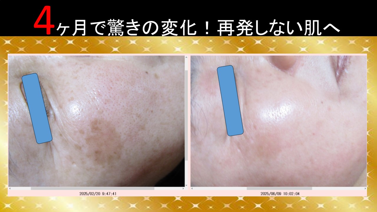 4ヶ月で驚きの変化！シミ再発しない肌へ