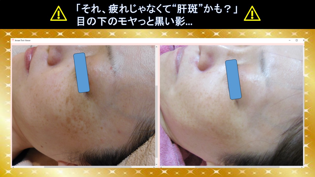 もう隠さない。肝斑、ケアしましょう