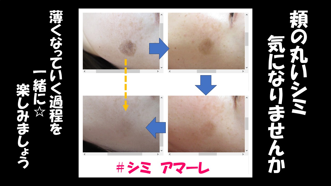 頬に丸いシミ気になりませんか？　　　　　　経過を確認しながら一緒に楽しみましょう
