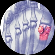 Sesamoiditis Myfootsteps Webseite