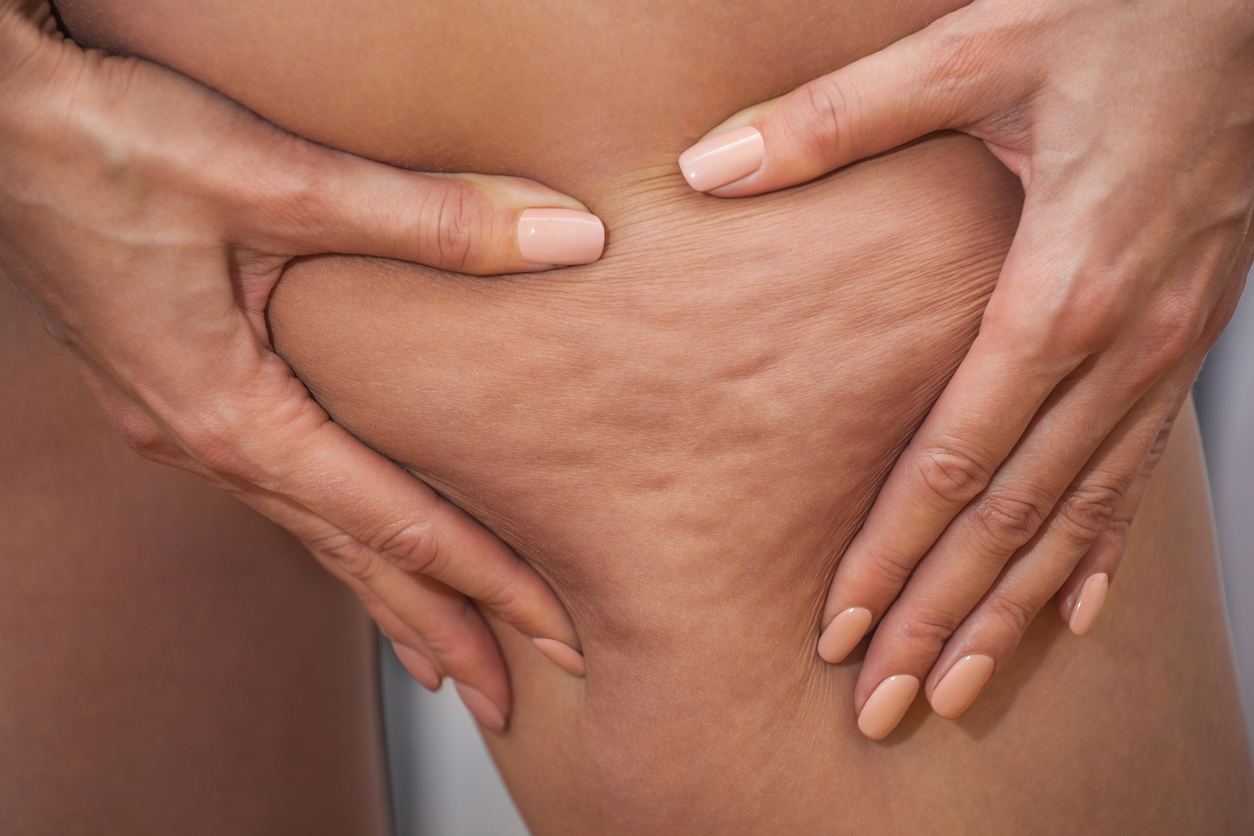 Stosswellen bei Cellulite