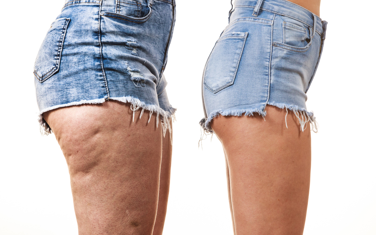 Microneedling Cellulite Basel