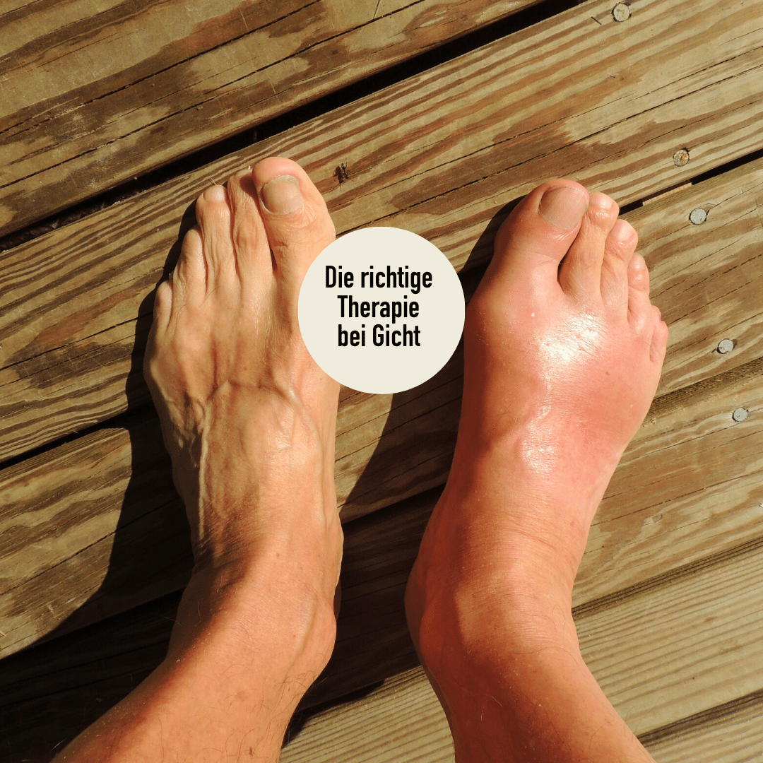 Gicht Therapie Basel
