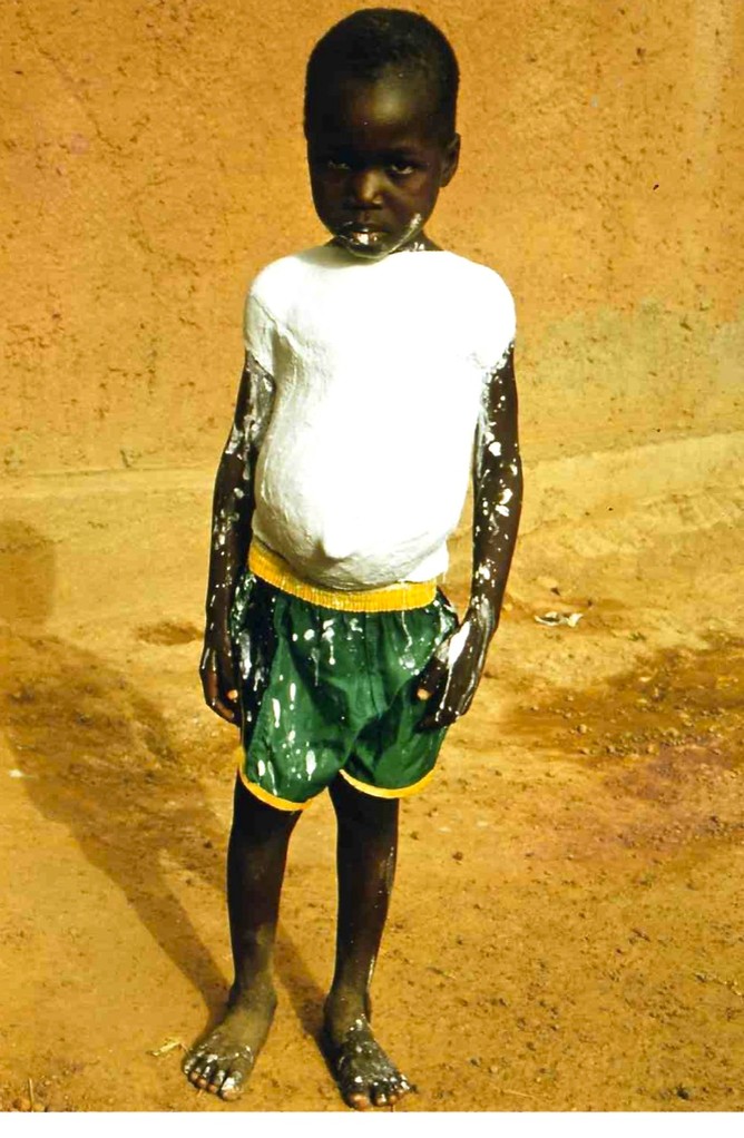 1997 : moulage sur nature, buste d’un enfant atteint de kwashiorkor, Koudougou.  Ce moulage deviendra une pièce majeure pour une installation : voir