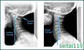 札幌市-ストレートネックを治すには正しい姿勢