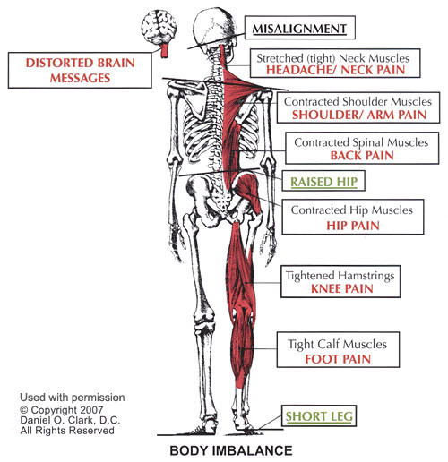 What Is Atlas Deviation Syndrome? advancedchirofl