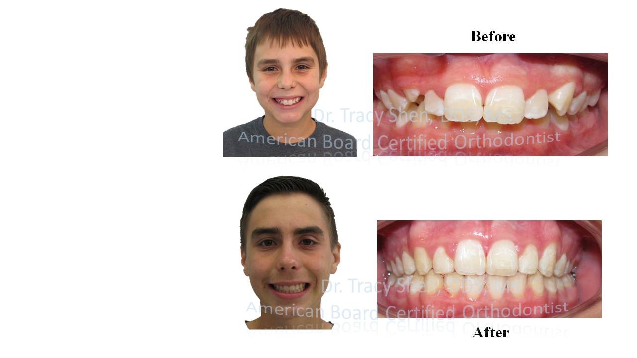Cl II non teeth removal treatment before and after