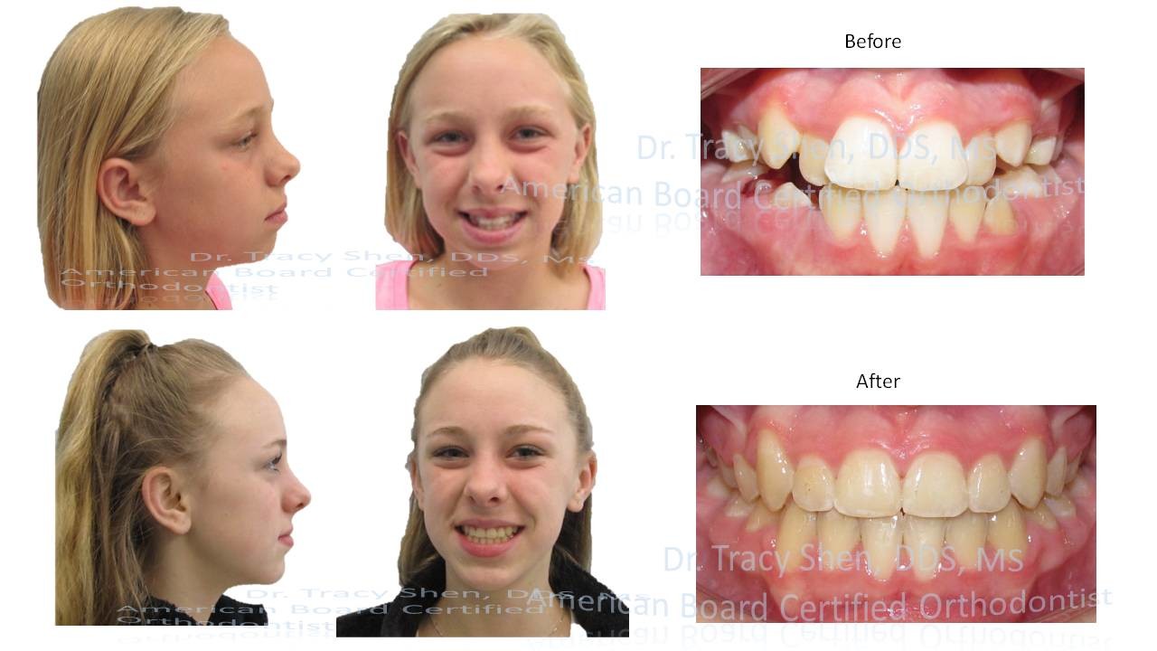 four premolars extraction orthodontic treatment before and after