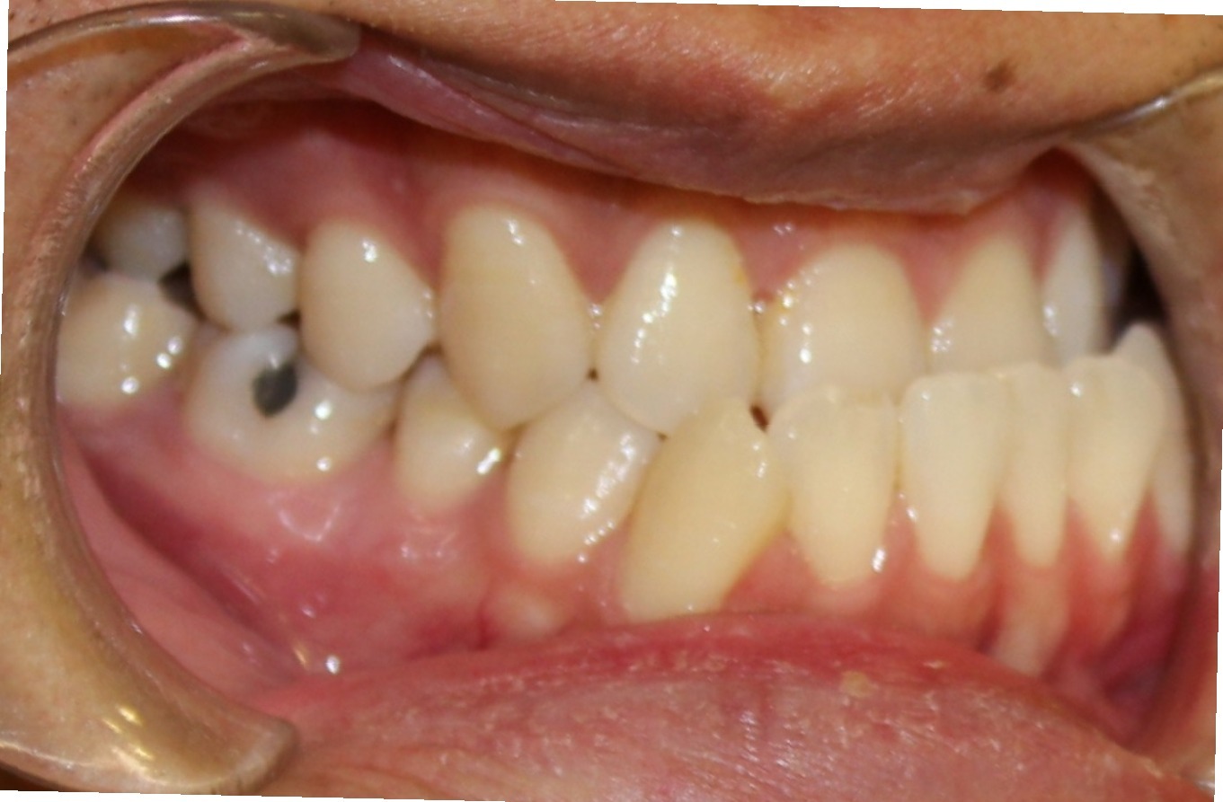 Orthognathic Jaw Surgery in Allen TX Suncreek Orthodontics in Allen