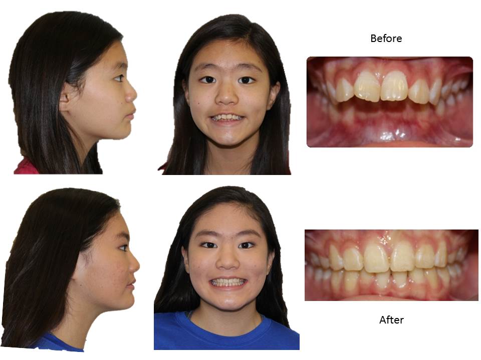 Two upper premolars removal treatment before and after