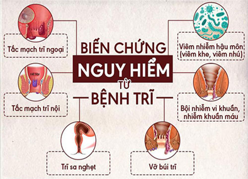 Bệnh trĩ cấp độ 1 nguy hiểm như nào