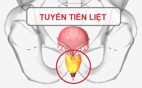 cách chữa viêm tuyến tiền liệt