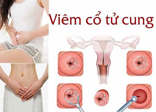 Bệnh viêm cổ tử cung