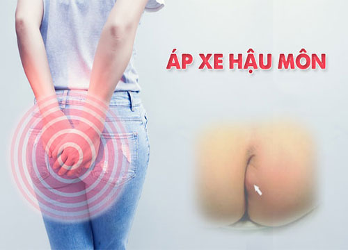 Apxe hậu môn