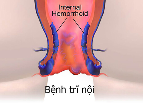 Bệnh trĩ nội