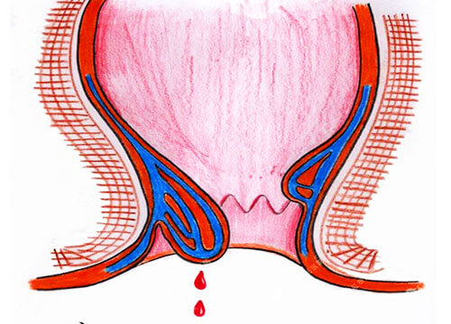Bệnh trĩ chảy máu