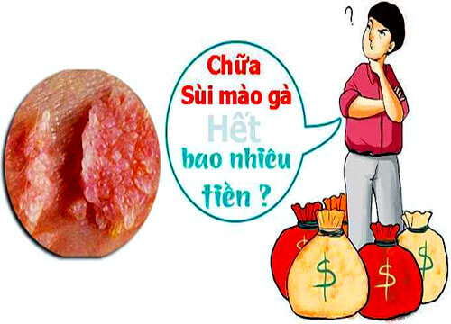 chi phí chữa sùi mào gà ở bắc giang