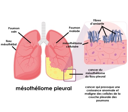 Le mésothéliome pleural, une maladie liée à l'amiante