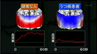 うつ病患者に見られる血液量低下