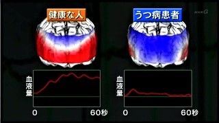 健康な人とうつ病患者の血流比較