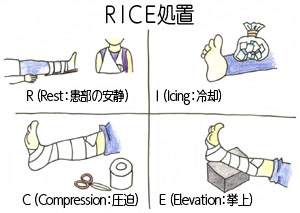 RICE処置とはRest（患部の安静）ーIcing（冷却）―Compression（圧迫）ーElevation（挙上）