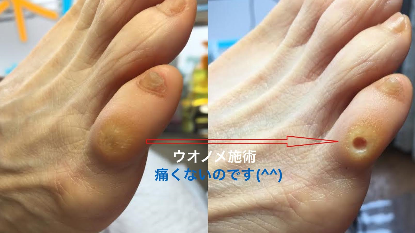 魚の目は放っておくと悪化して歩行時などに痛みをともなうため 早めの対処が必要です 公式 福岡市 足と足 ケア専門店 Dr ネイル爪革命福岡けやき通り店 巻き爪 魚の目 魚の目は放っておくと悪化して歩行時などに痛みをともなうため 早めの対処が必要です 公式 福岡市 足と足 ケア専門店 Dr ネイル爪革命福岡けやき通り店 巻き爪 魚の目