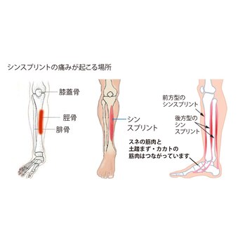 シンスプリント？その痛み取れますよ！