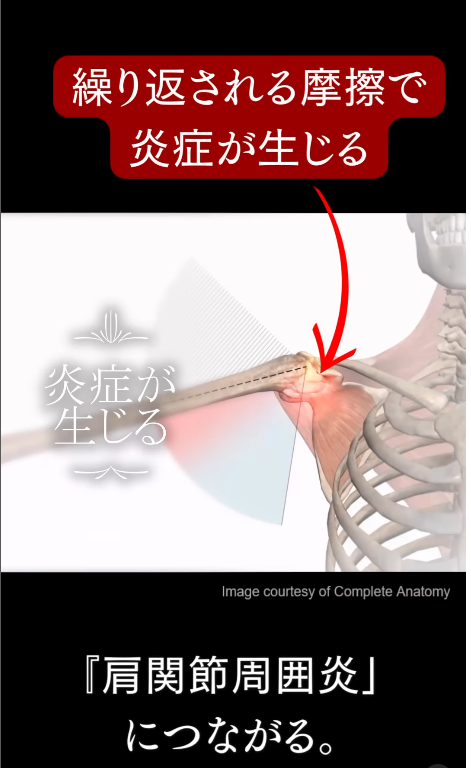 肩関節周囲炎