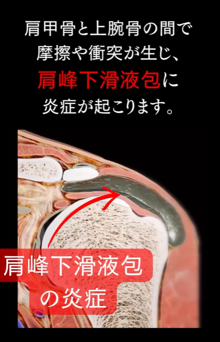 肩峰下インピンジメント症候群