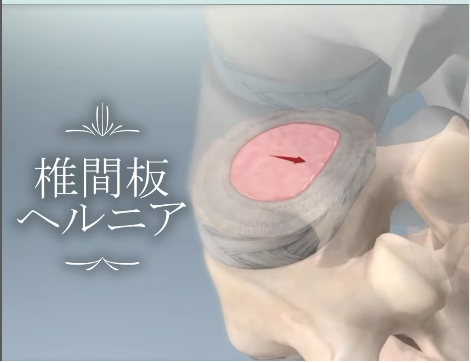 腰椎椎間板ヘルニア