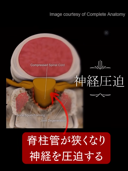 脊柱管狭窄症