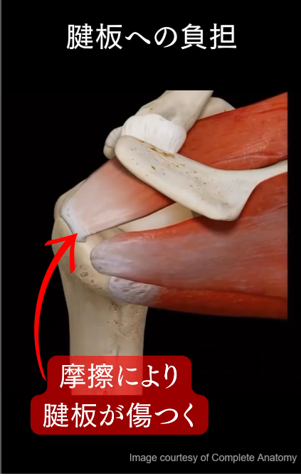 腱板断裂の病態とケア