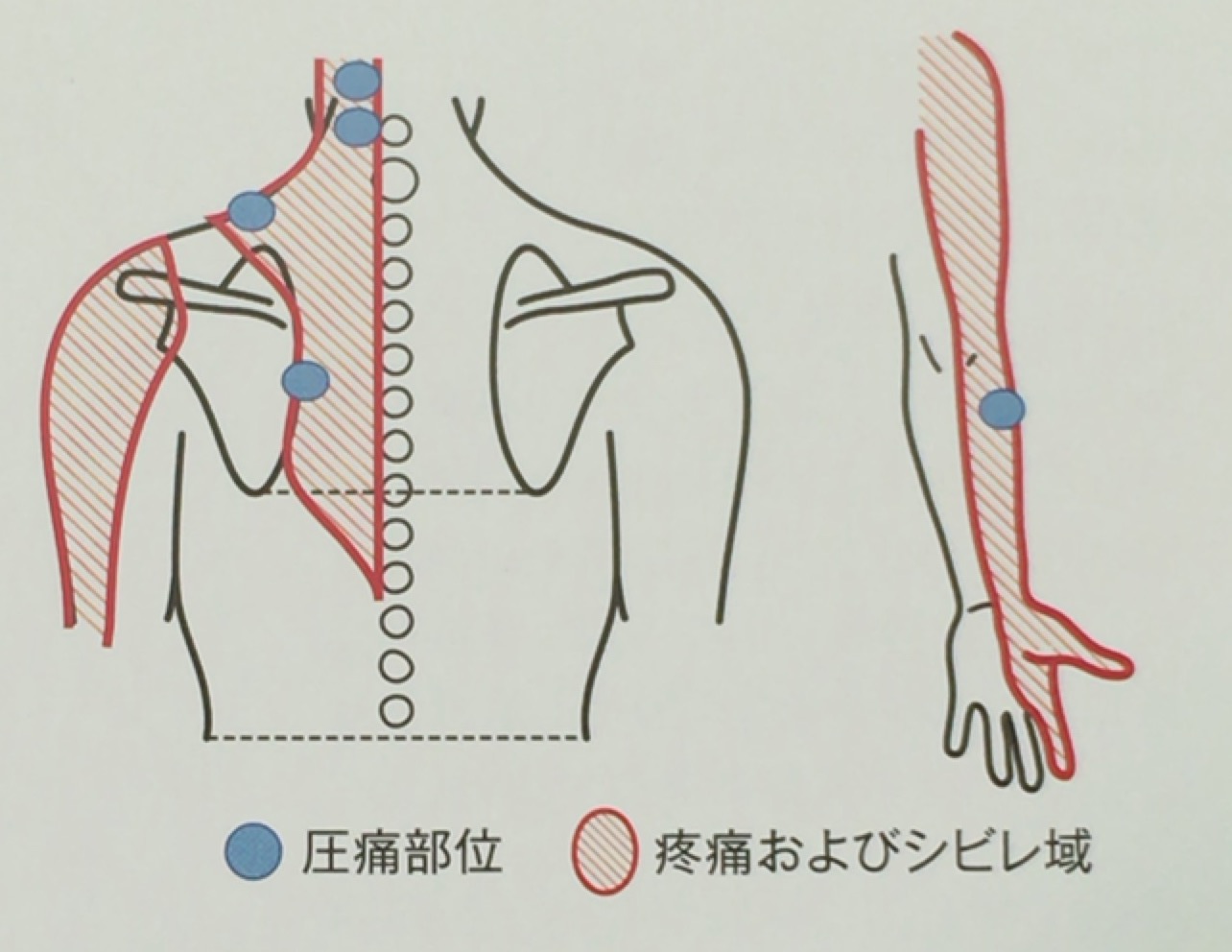 鍼灸事例７「頸から腕の痛みとしびれ」